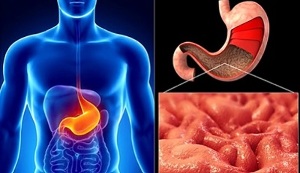 胃炎の栄養規則